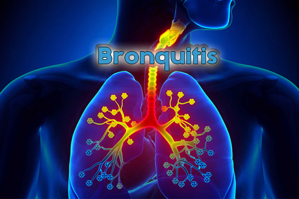 Bronquitis Qu Es S Ntomas Y Tratamiento Off